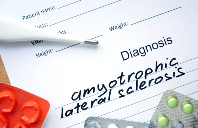 An introduction to amyotrophic lateral sclerosis (ALS) and its causes